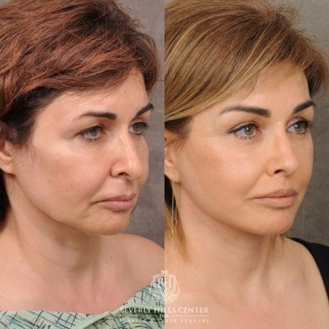 rhinoplasty experts