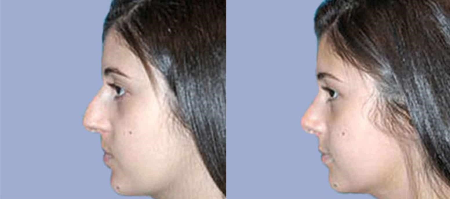 rhinoplasty experts