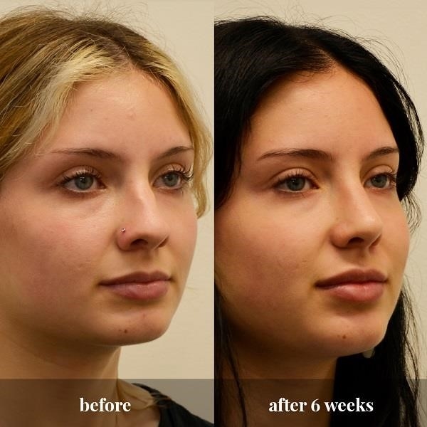 rhinoplasty experts
