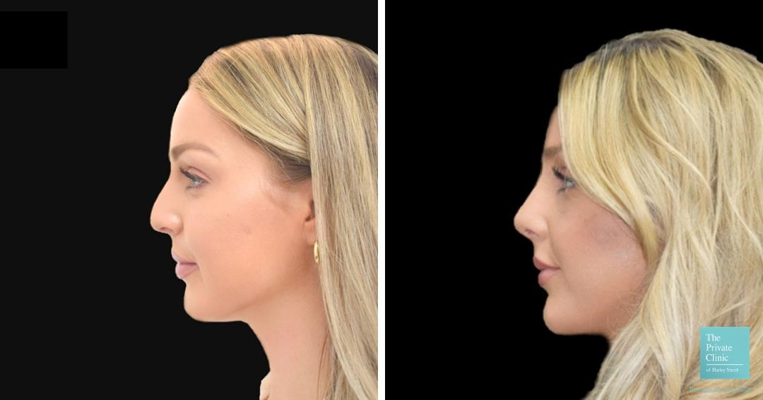 open vs closed rhinoplasty