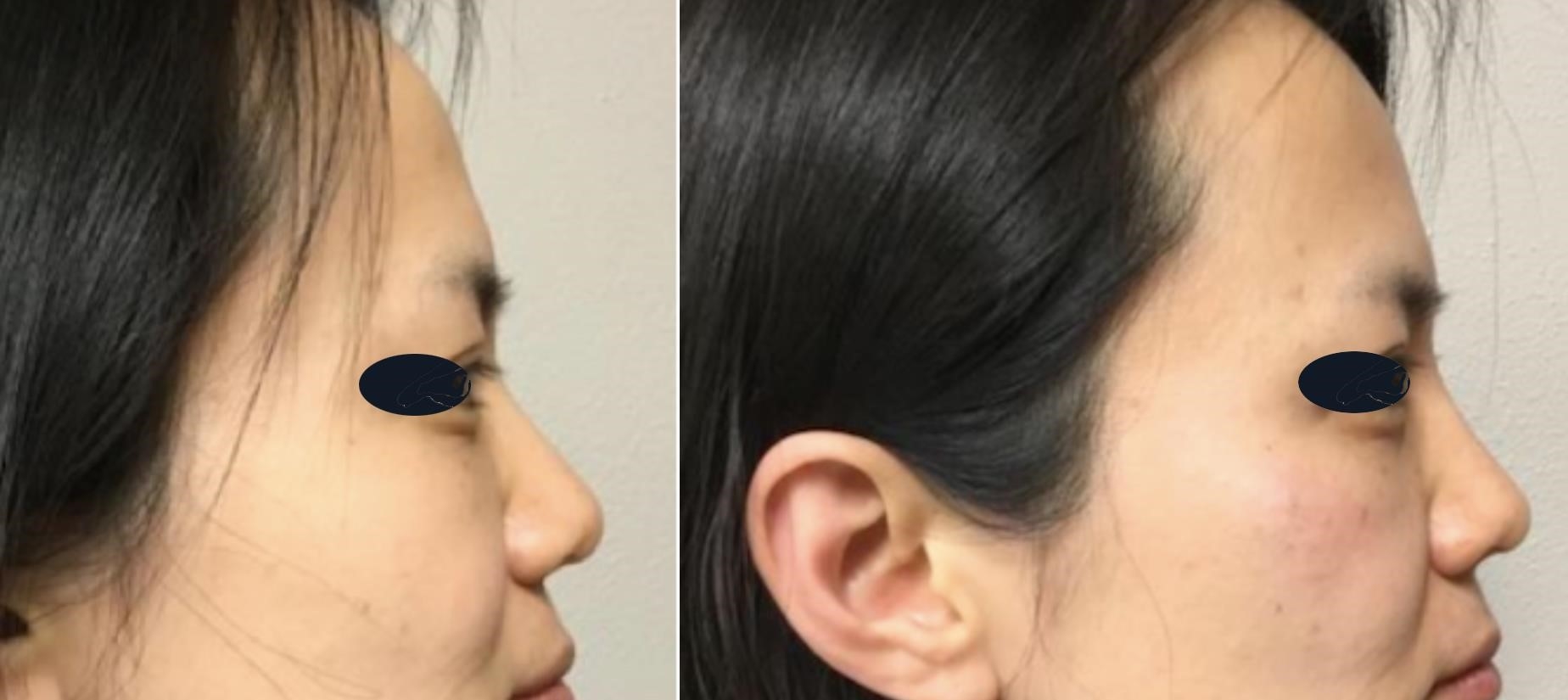 open vs closed rhinoplasty